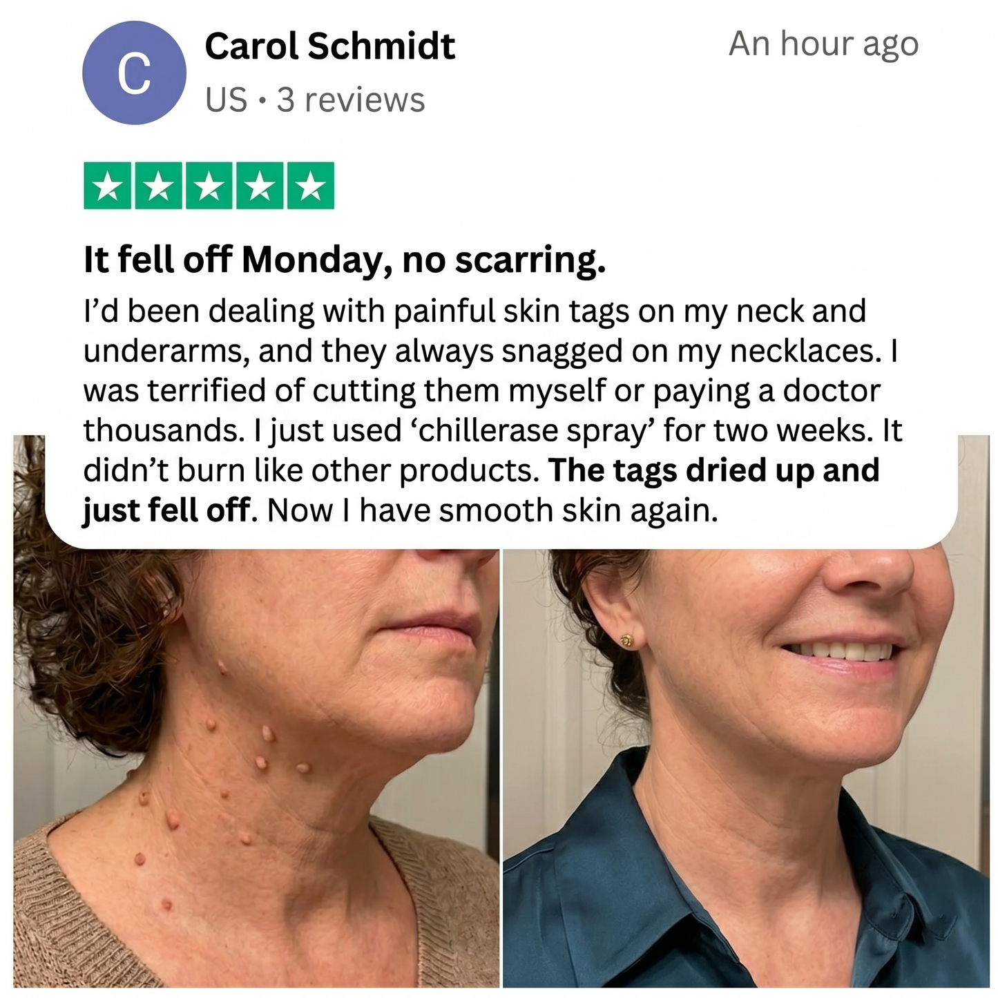 ChillErase® Bump Renewal Spray